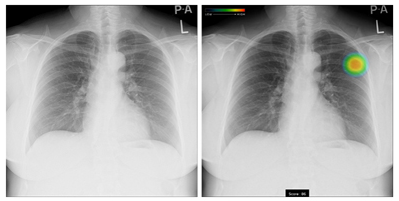 胸部レントゲンAI画像診断支援システム CXR-AIDw