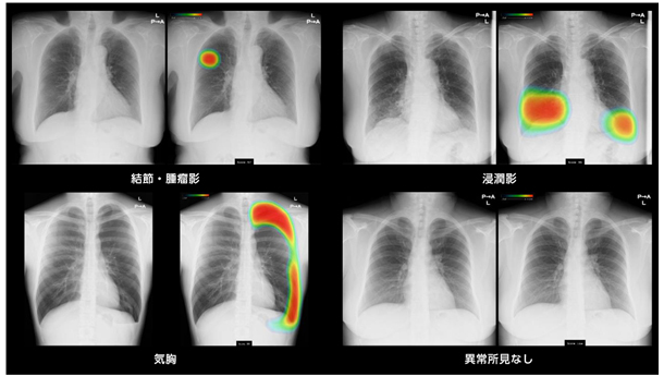 胸部レントゲンAI画像診断支援システム CXR-AID